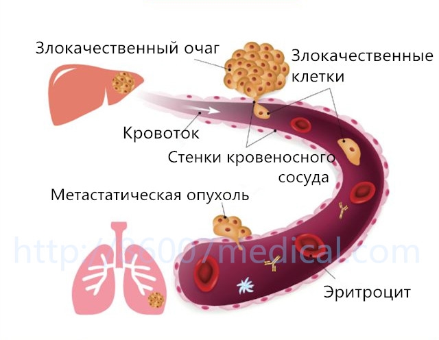 Обобщим распространенные пути метастазирования опухоли (Часть 1)